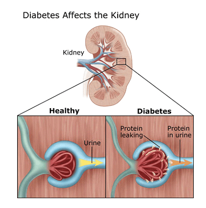 Diabetic Kidney Disease (Diabetic Nephropathy)